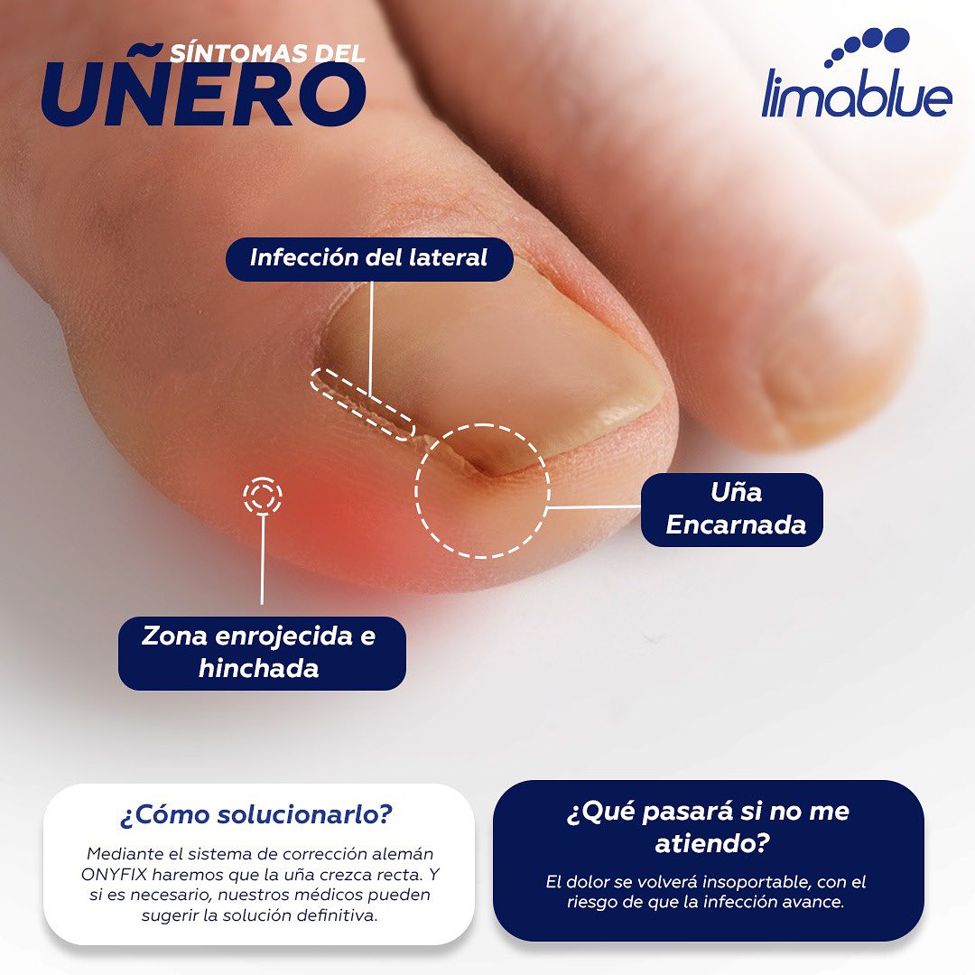Síntomas del uñero: borde lateral de la uña enrojecido e hinchado y uña encarnada