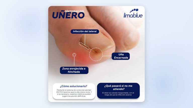 Atención de uñeros en Lima en Limablue: síntomas del uñero o uña encarnada