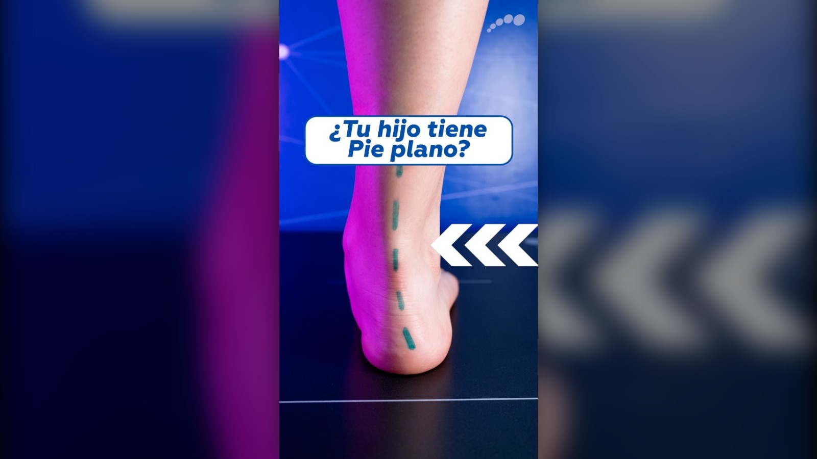¿Tu hijo tiene pie plano? Evaluación de la pisada infantil en Limablue