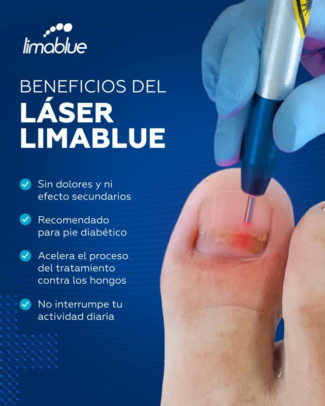 Láser para hongos en las uñas en Limablue