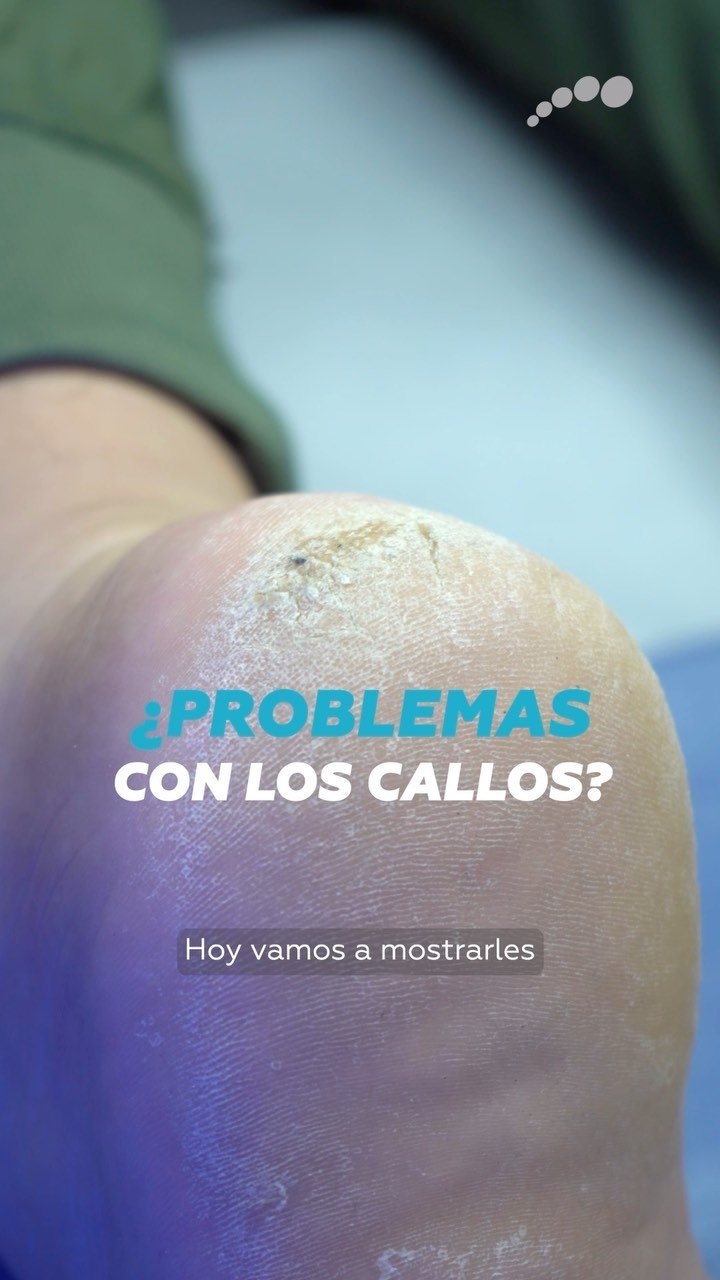 Talón y planta del pie con callosidad antes del retiro en un consultorio de Limablue