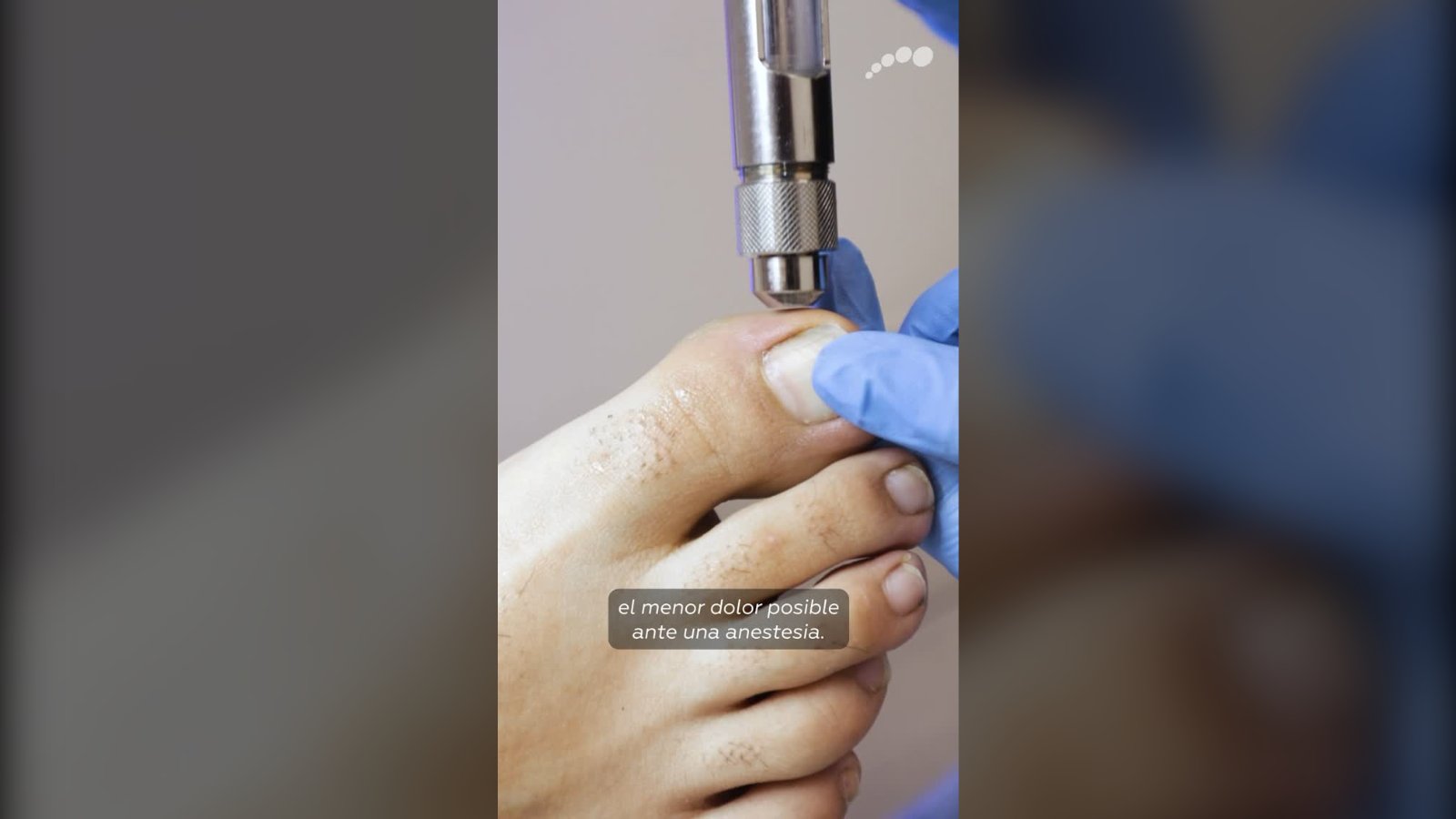 Cabezal metálico de Dermojet, la jeringa sin aguja, apoyado sobre el dedo gordo del pie para aplicar anestesia sin aguja en Limablue