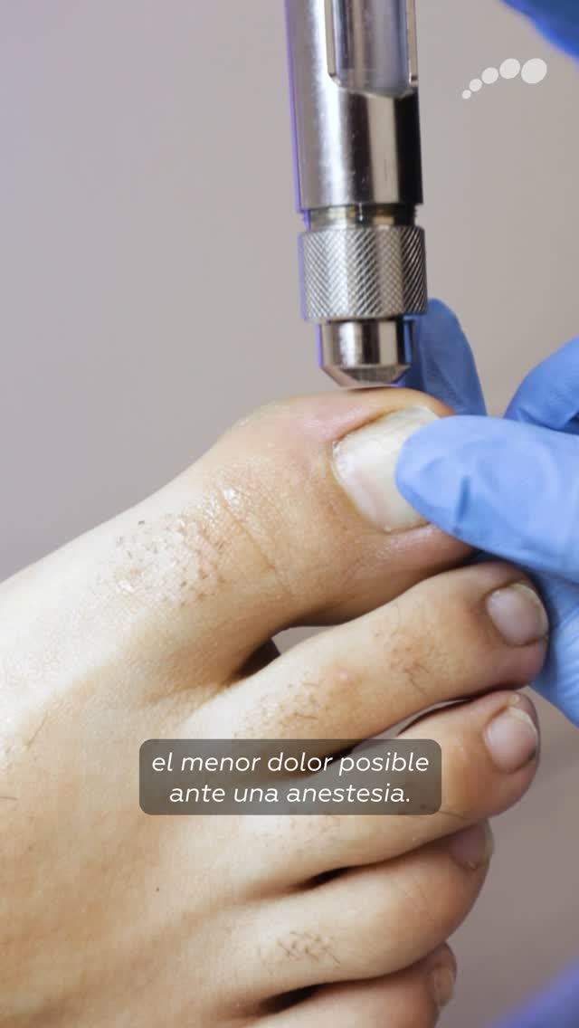 Aplicación con Dermojet en un dedo del pie antes de la anestesia del uñero en Limablue