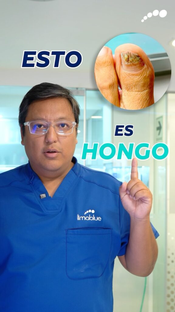 Especialista de Limablue explica cómo diagnosticar si una lesión del pie es hongo