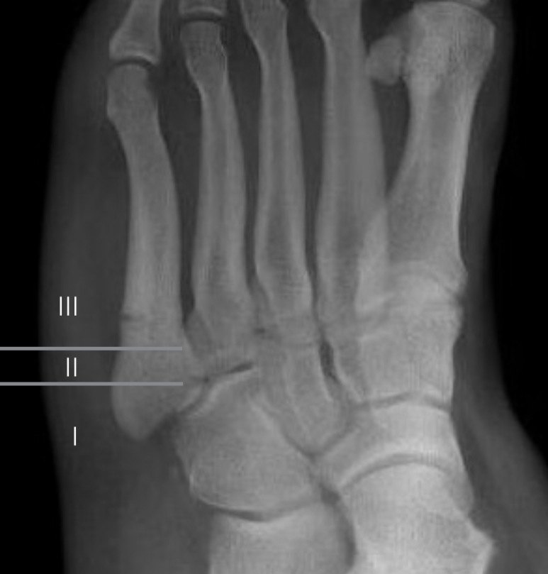 Zonas de fractura de la base del quinto metatarsiano