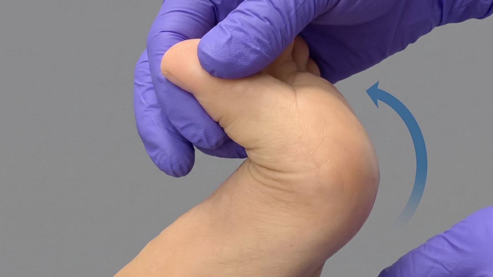 Exploración del dedo gordo del pie: el profesional lo flexiona hacia arriba para evaluar su movilidad (hallux limitus)