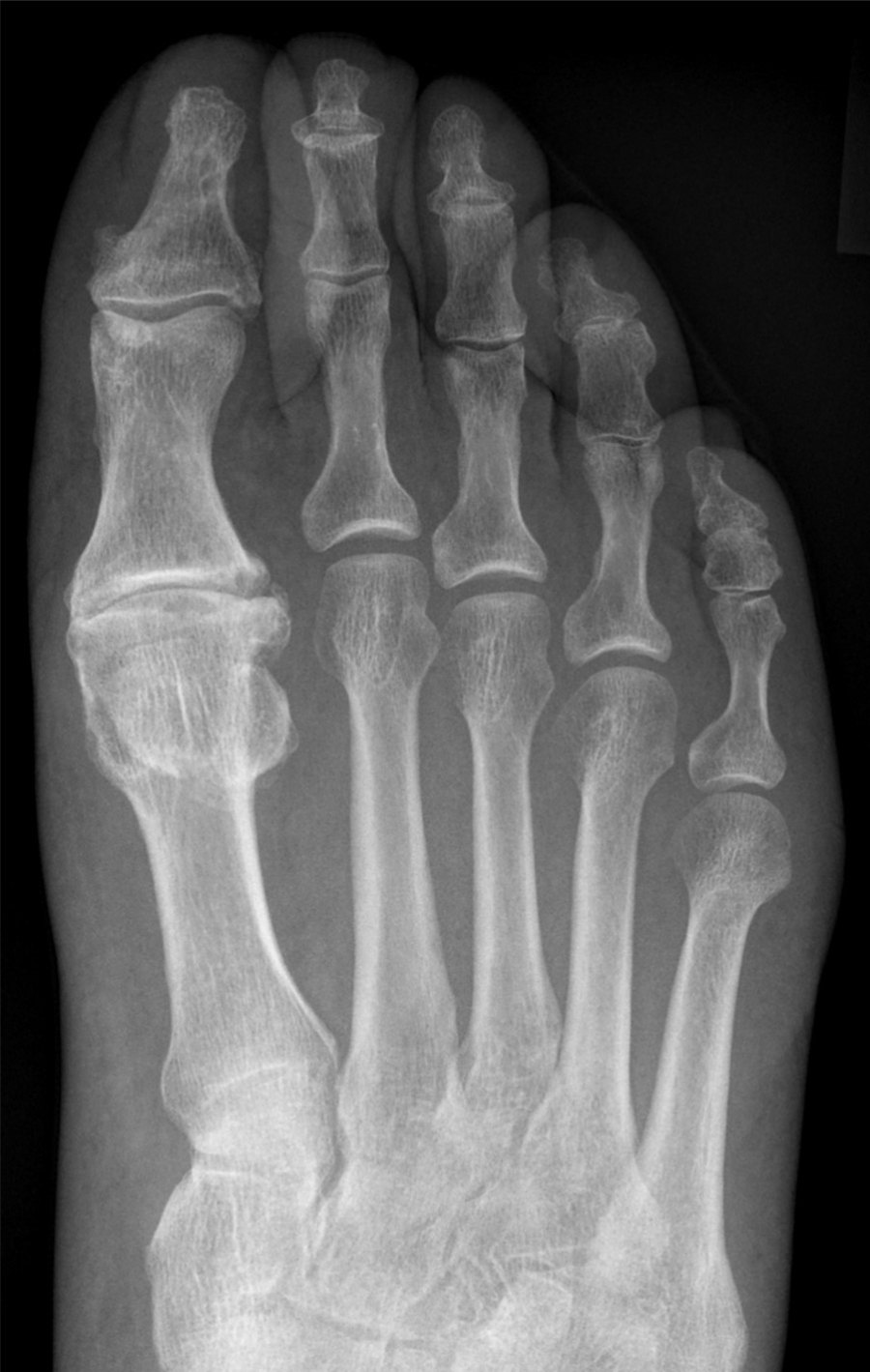 Radiografía de hallux rigidus: artrosis de la articulación del dedo gordo