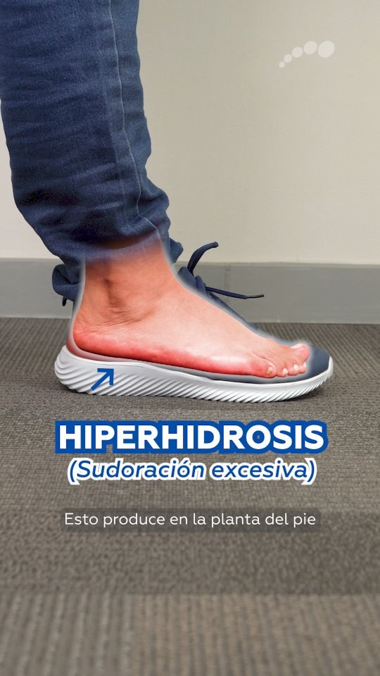 Hiperhidrosis: sudoración excesiva en la planta del pie