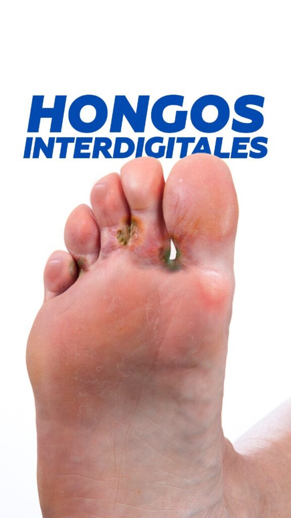 Hongos interdigitales: pie de atleta entre los dedos del pie