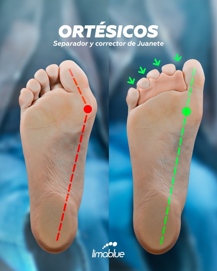 Gráfico de dos plantas de pies con líneas de alineación y el texto «Ortésicos: separador y corrector de juanete»