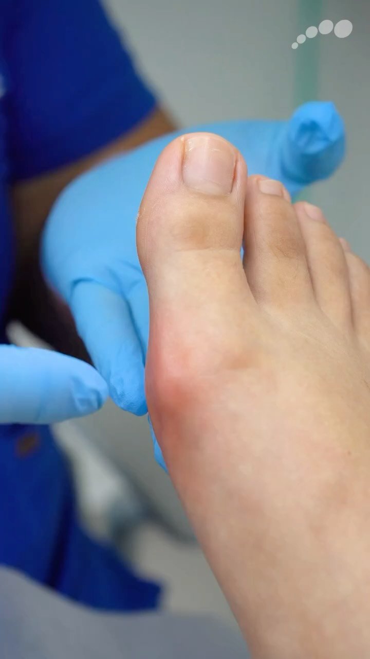 Pie con juanete (hallux valgus) visto de cerca, sostenido por manos con guantes