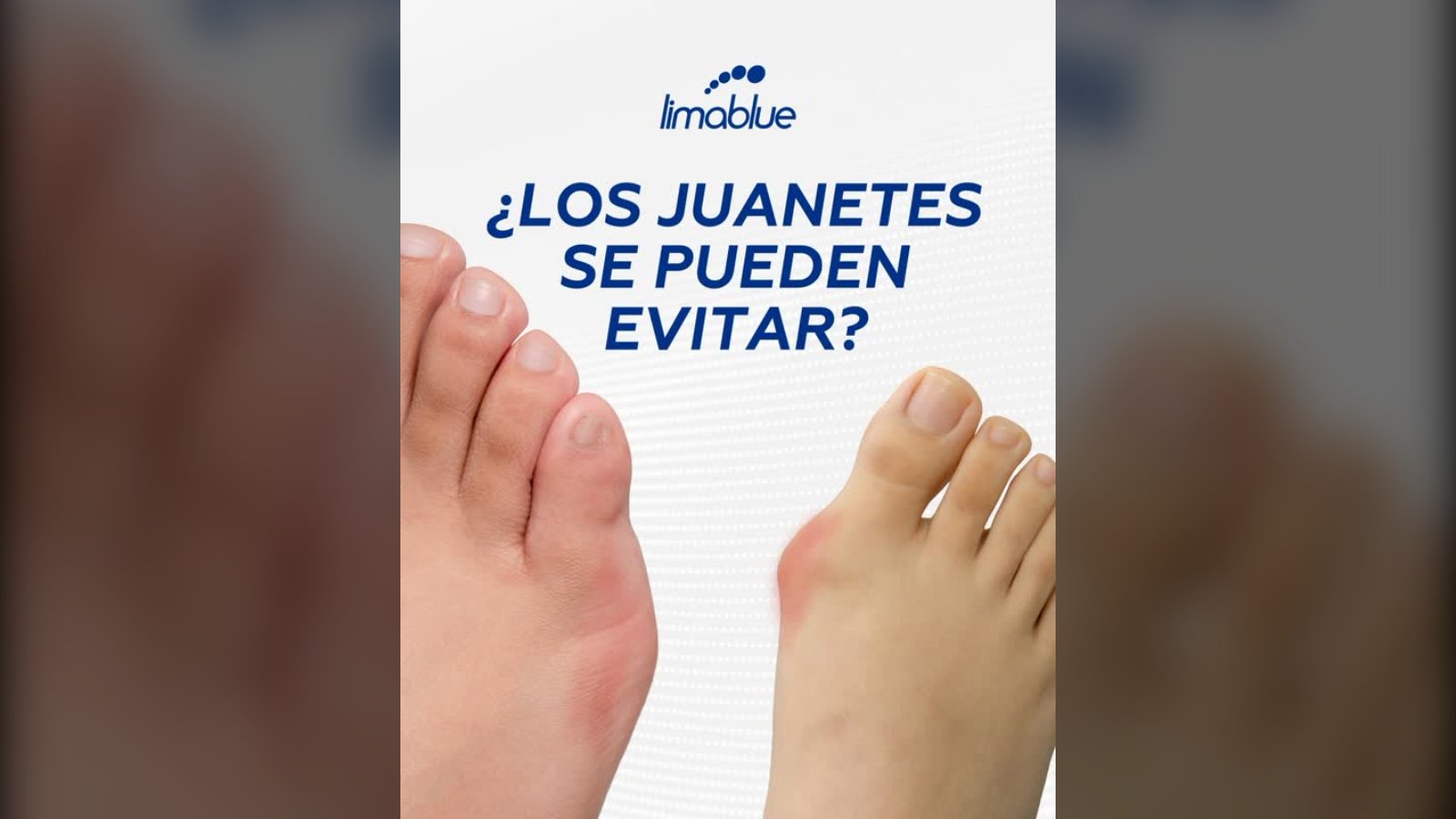 Dos pies con juanete (hallux valgus) vistos de cerca, con el texto «¿Los juanetes se pueden evitar?»