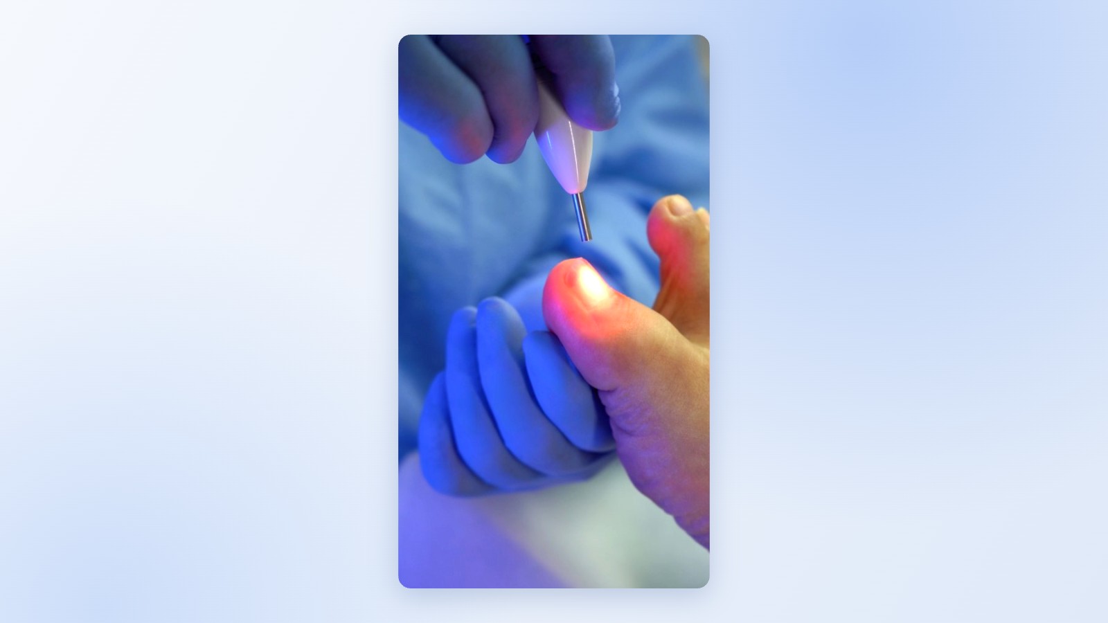 Láser para hongos en las uñas en Limablue