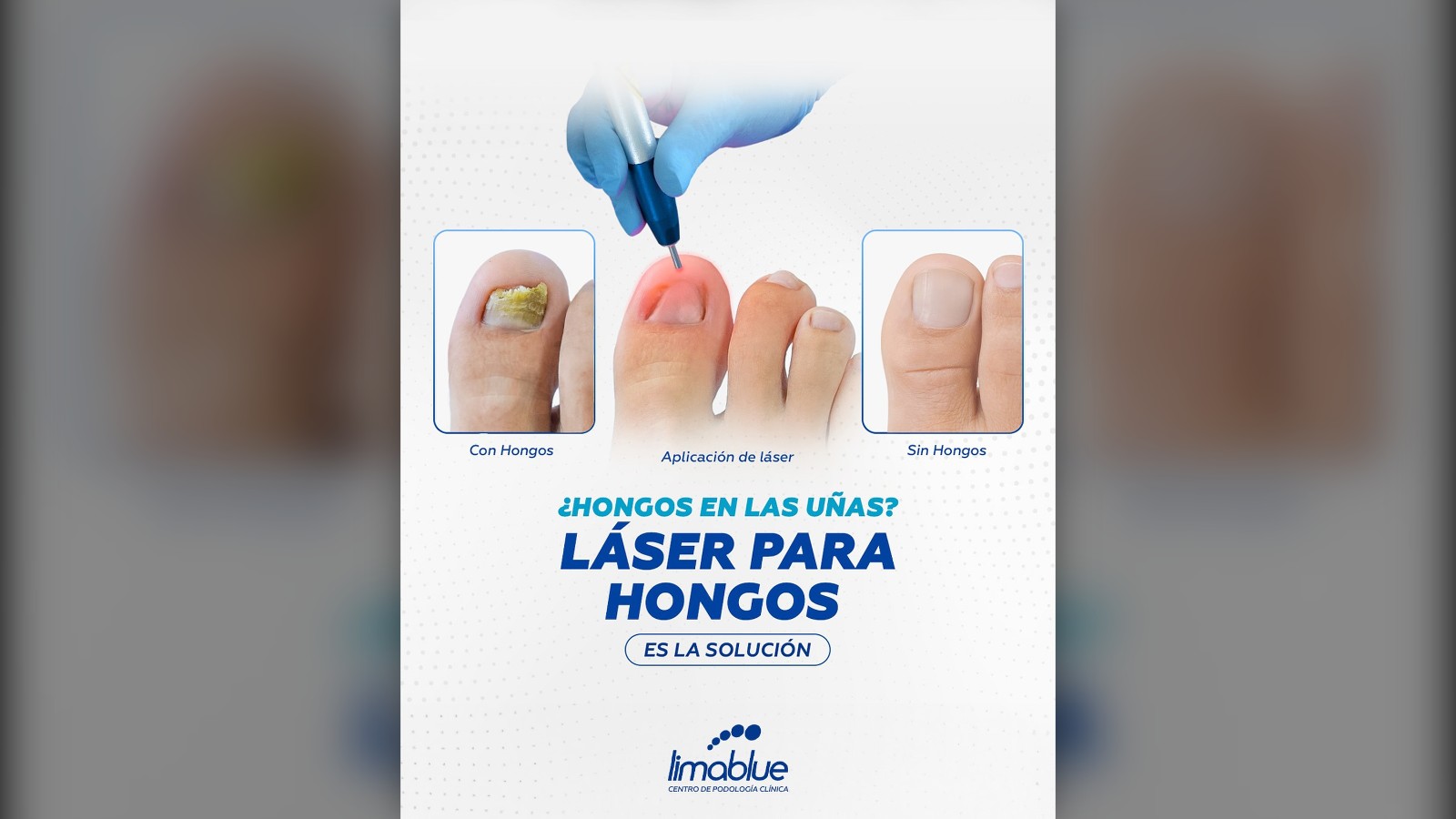 ¿Hongos en las uñas? Láser para hongos de Limablue: antes y después de la uña