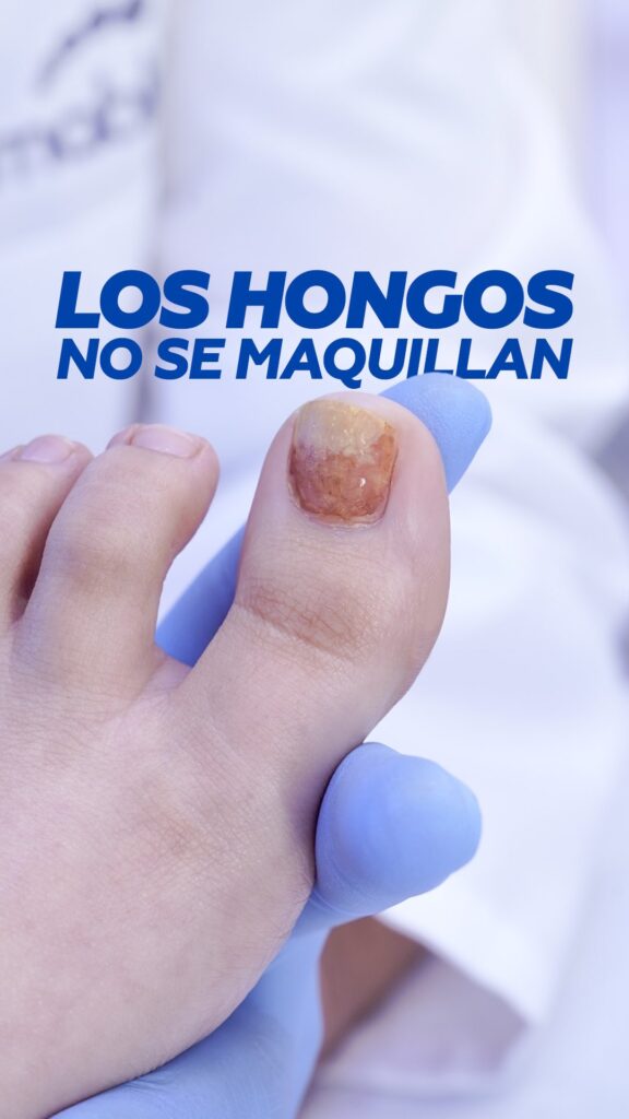 Los hongos no se maquillan: uña del pie con hongos tratada en Limablue