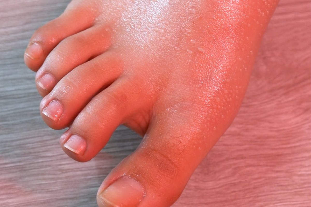 Olor de pies muy fuerte: pie con sudor y bacterias