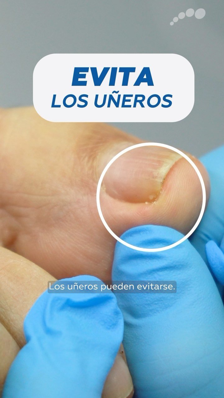 Uña del dedo gordo del pie con la zona donde va el corrector Onyfix resaltada; gráfica de Limablue «Evita los uñeros»
