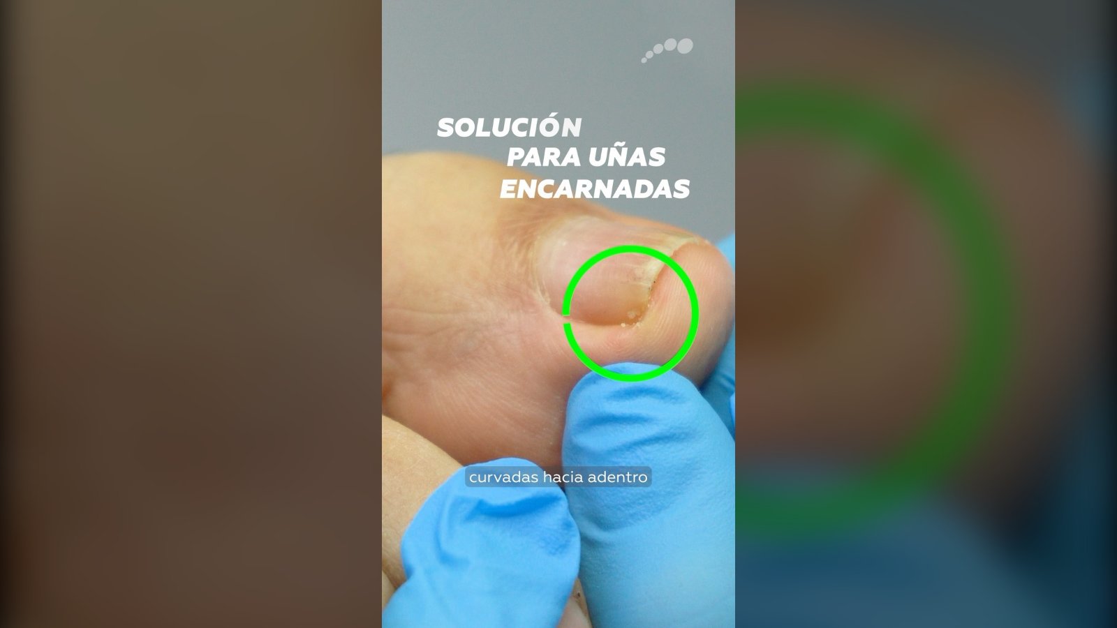 Uña del dedo gordo del pie con la zona tratada con Onyfix resaltada con un círculo; gráfica de Limablue «Solución para uñas encarnadas»