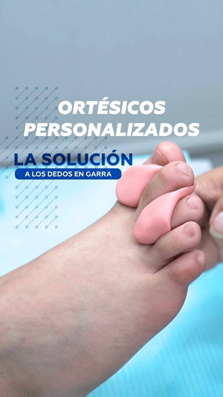 Ortésico de silicona a medida colocado en los dedos del pie en Limablue