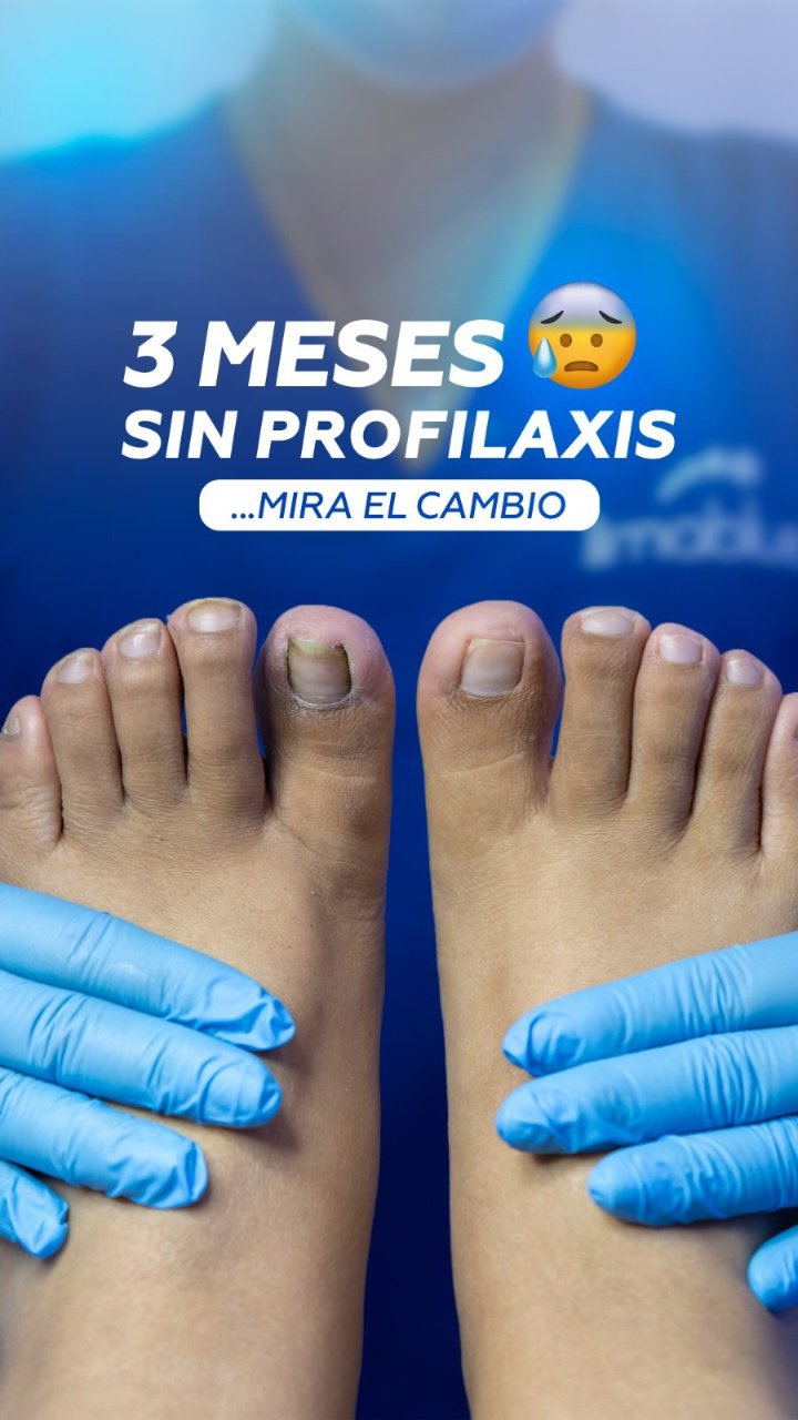 Los dos pies de un paciente, vistos de frente y sostenidos por manos con guantes, antes de la profilaxis podológica en Limablue