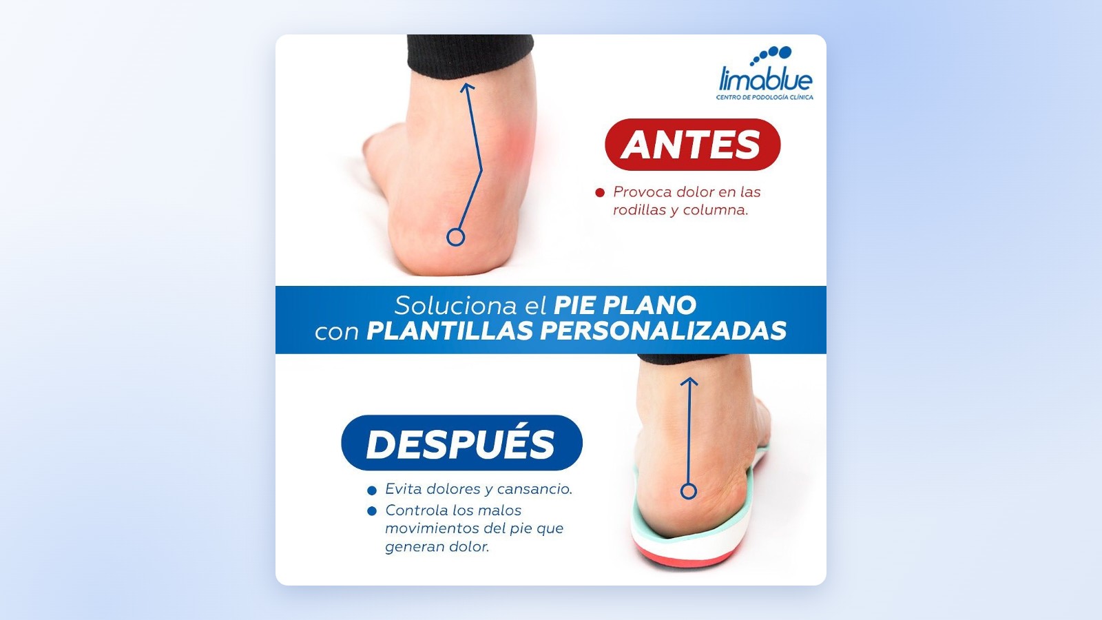 Plantillas para pie plano en adultos: antes y después