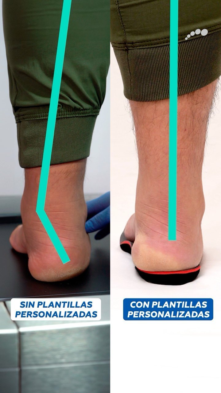 Corrección de la pronación con plantillas personalizadas