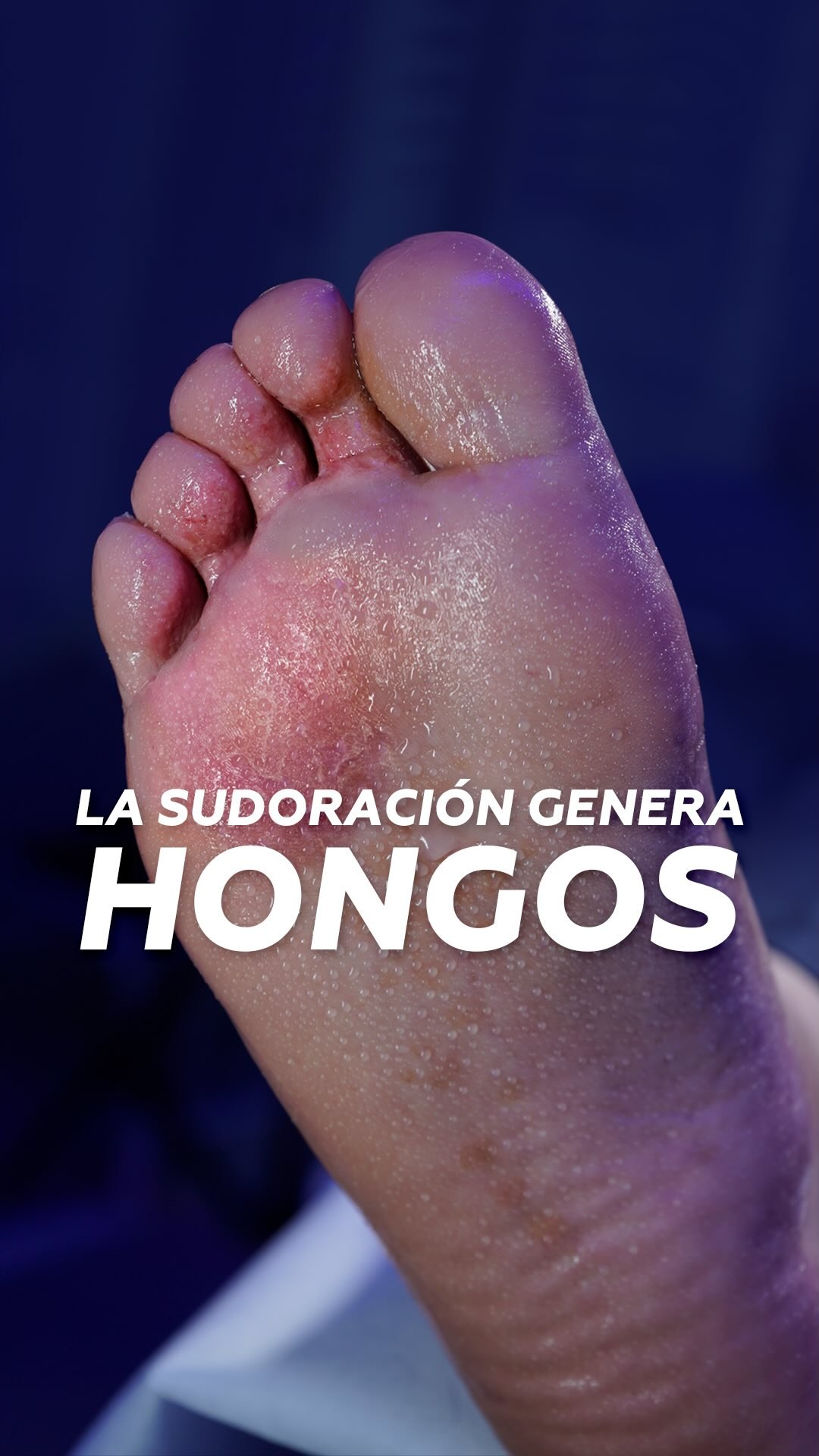 La sudoración excesiva en los pies favorece los hongos