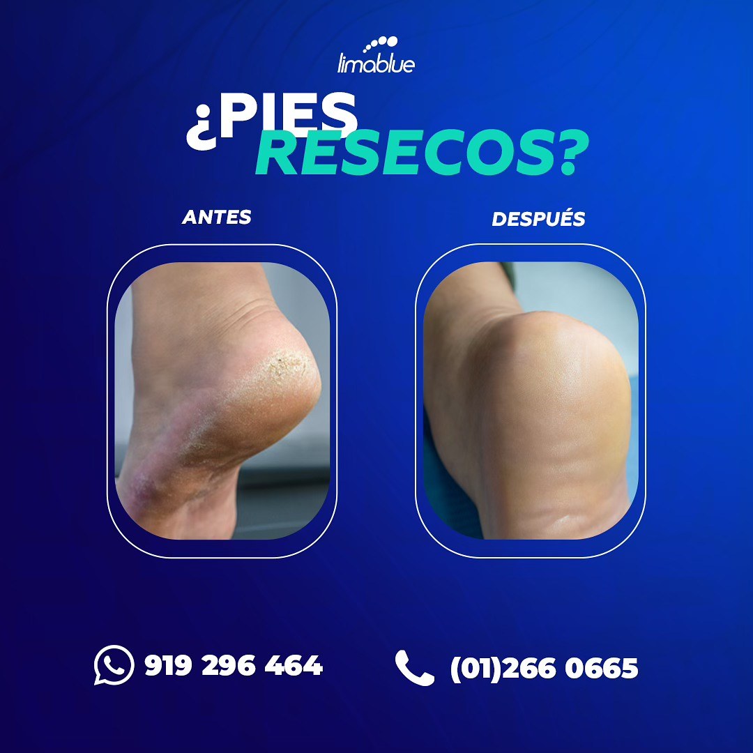 Talones resecos antes y después de la profilaxis en Limablue