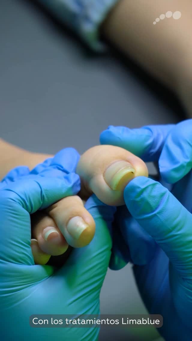 Manos con guantes trabajando con instrumental sobre la uña del dedo gordo del pie en Limablue