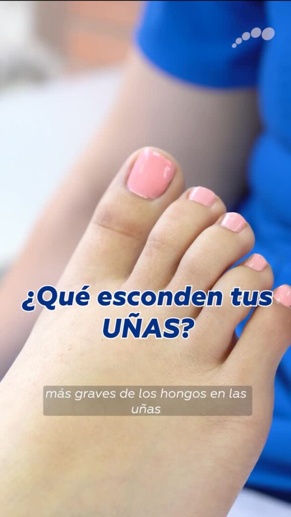Uñas de los pies con hongos, engrosadas y amarillentas
