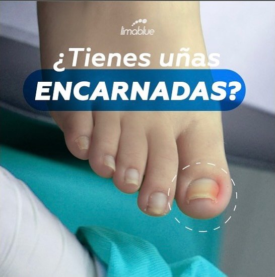 Dedo gordo del pie con uña encarnada y el borde enrojecido; gráfica de Limablue «¿Tienes uñas encarnadas?»